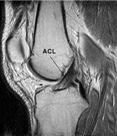 anterior-cruciate-ligament-