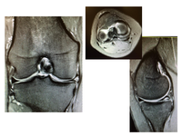 Intrameniscal cyst