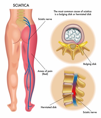 Slipped disc
