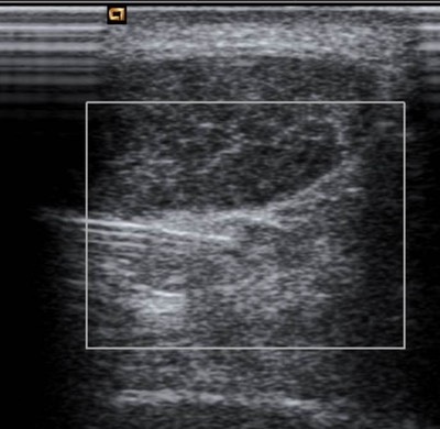 US-guided injection